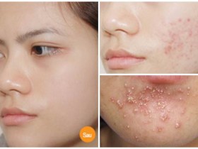 Đánh tan nốt mụn xấu xí giúp da trắng tinh khôi với 4 bí quyết chưa đến 15 phút