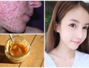 Mụn hết sạch, da trắng lên rõ rệt chỉ cần thoa hỗn hợp rẻ bèo này là đủ