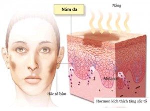 Nguyên nhân gây nám da mặt, cách chữa trị và phòng tránh